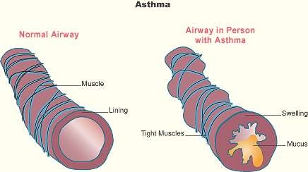 Luftvägarna vid astma